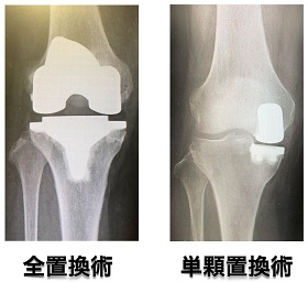 全置換術と単顆置換術