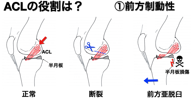 図③: ACLによる前方安定性