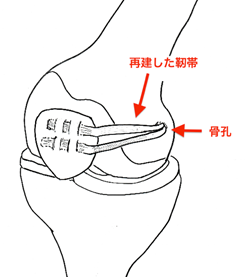 図6: 再建術後(当院で採用している術式)