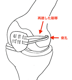 図6: 再建術後（当院で採用している術式）