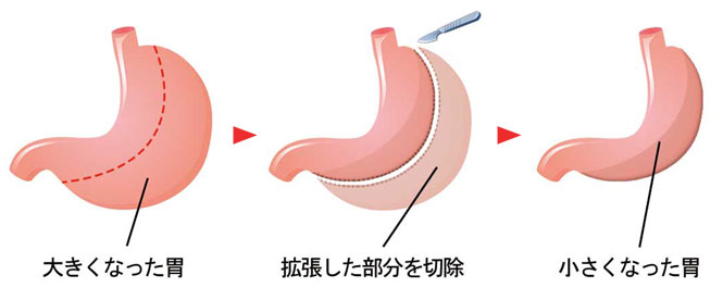 腹腔鏡下スリーブ状胃切除術