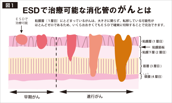 ESDで治療可能な消化管のがんとは