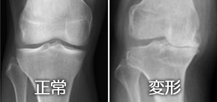 変形性膝関節症